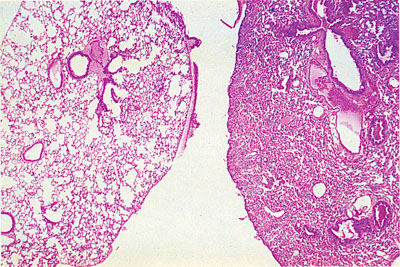 Pulmonary Atelectasis; Atelectasis, Congestive; Lung Collapse