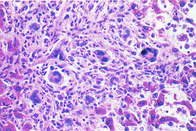 histiocytic sarcoma in dogs color atlas of neoplastic and non neoplastic lesions in aging mice figure 302 histiocytic sarcoma in dogs color atlas of neoplastic and non neoplastic lesions in aging mice figure 302