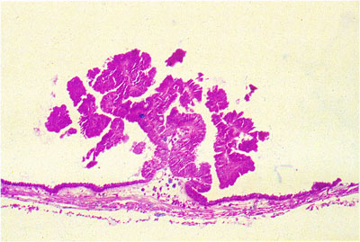 papilloma in gallbladder)