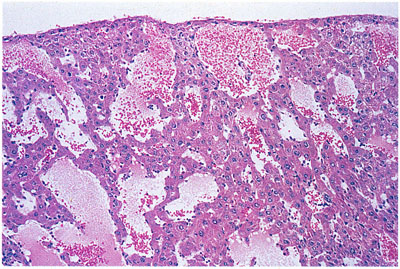 Hepatic Angiectasis