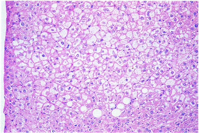 Hepatocellular Clear Cell Focus